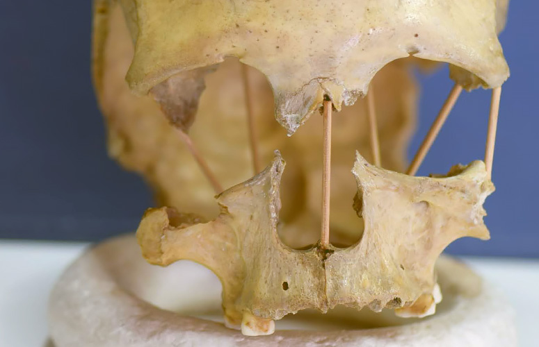El cráneo de Pestera Muierii, cuyo genoma completo ahora se ha secuenciado con éxito.
