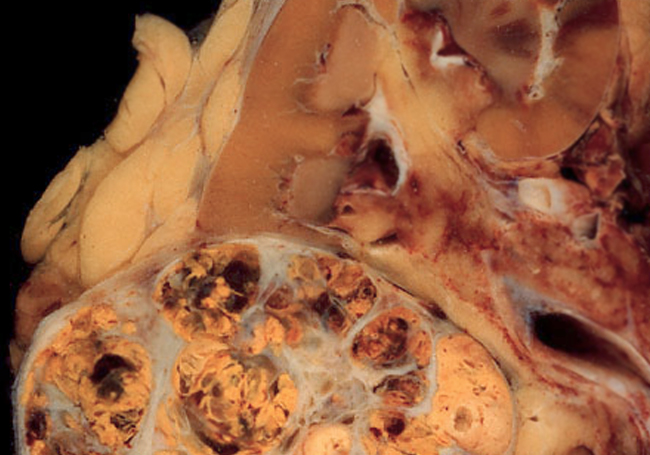 Imagen de un carcinoma renal (Ed Uthman)