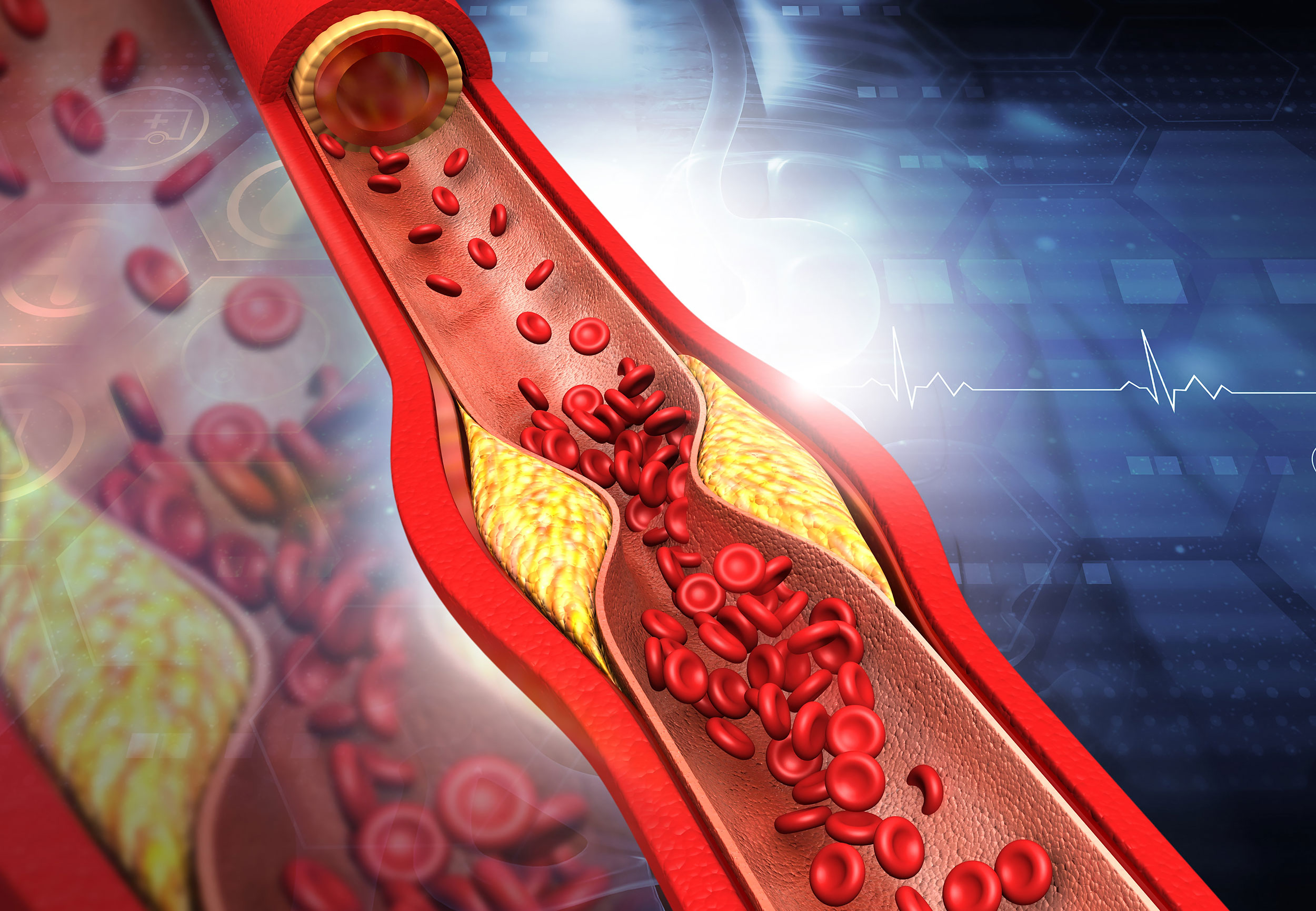 Familial Hypercholesterolaemia